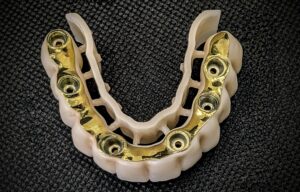 Read more about the article Prótesis de zirconio sobre barras Blender: estética, precisión y durabilidad en prótesis dentales